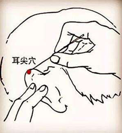 11中医治疗7-耳尖放血.jpg 11中医治疗7-耳尖放血.jpg